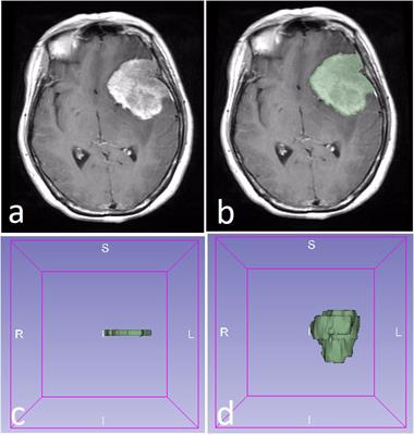 Performance comparison of 2D and 3D MRI radiomics features in meningioma grade prediction: A preliminary study